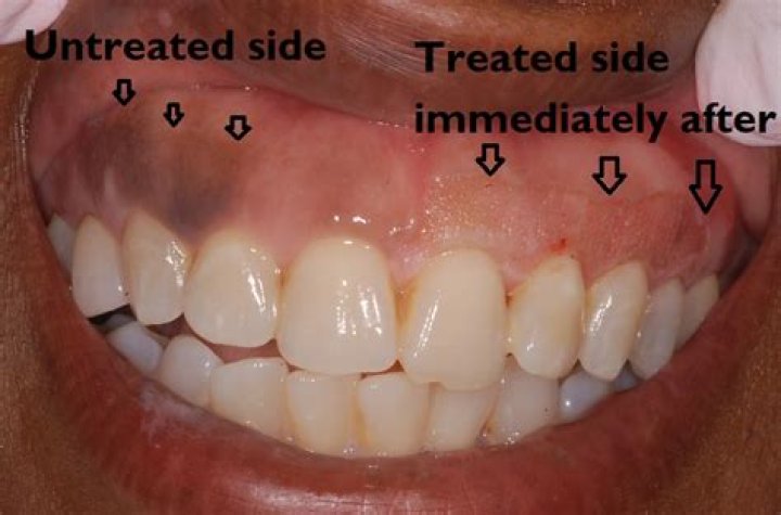 How to get rid of dark gums